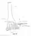 Fig. 14 - METHODS AND INSTRUMENTS FOR SUBCHONDRAL TREATMENT OF OSTEOARTHRITIS IN A SMALL JOINT