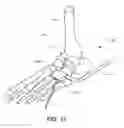 Fig. 16 - METHODS AND INSTRUMENTS FOR SUBCHONDRAL TREATMENT OF OSTEOARTHRITIS IN A SMALL JOINT
