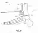 Fig. 23 - METHODS AND INSTRUMENTS FOR SUBCHONDRAL TREATMENT OF OSTEOARTHRITIS IN A SMALL JOINT