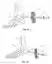 Fig. 24 - METHODS AND INSTRUMENTS FOR SUBCHONDRAL TREATMENT OF OSTEOARTHRITIS IN A SMALL JOINT