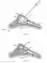 Fig. 08 - Devices and methods for guiding a surgical instrument