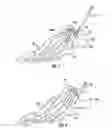 Fig. 05 - Bone implant and means of insertion