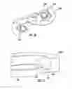 Fig. 32 - Bone implant and means of insertion