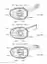 Fig. 34 - Electrosurgical device
