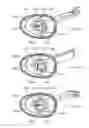 Fig. 34 - Electrosurgical device