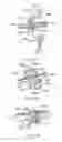 Fig. 22 - Electrosurgical device