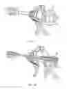 Fig. 31 - Electrosurgical device