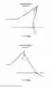 Fig. 29 - ELECTROSURGICAL DEVICE