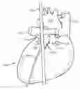 Fig. 01 - Method to Protect the Espohagus and Other Mediastinal Structures During Cardiac and Thoracic Interventions