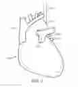 Fig. 02 - Method to Protect the Espohagus and Other Mediastinal Structures During Cardiac and Thoracic Interventions