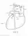 Fig. 03 - Method to Protect the Espohagus and Other Mediastinal Structures During Cardiac and Thoracic Interventions