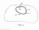 Fig. 04 - Method to Protect the Espohagus and Other Mediastinal Structures During Cardiac and Thoracic Interventions