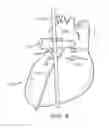 Fig. 09 - Method to Protect the Espohagus and Other Mediastinal Structures During Cardiac and Thoracic Interventions