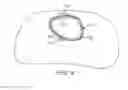 Fig. 10 - Method to Protect the Espohagus and Other Mediastinal Structures During Cardiac and Thoracic Interventions