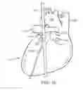 Fig. 11 - Method to Protect the Espohagus and Other Mediastinal Structures During Cardiac and Thoracic Interventions