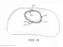 Fig. 12 - Method to Protect the Espohagus and Other Mediastinal Structures During Cardiac and Thoracic Interventions