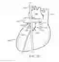 Fig. 13 - Method to Protect the Espohagus and Other Mediastinal Structures During Cardiac and Thoracic Interventions