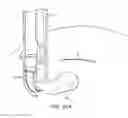 Fig. 40 - ILLUMINATED AND MODULAR SOFT TISSUE RETRACTOR