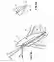 Fig. 04 - APPARATUS FOR EVACUATION OF ROOT CANAL