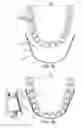 Fig. 08 - Apparatus for achieving molar distalization