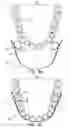 Fig. 09 - Apparatus for achieving molar distalization