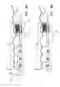 Fig. 11 - Apparatus for achieving molar distalization