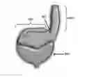 Fig. 01 - Method of bladder augmentation with modified ileal segment and biologically compatible tissue