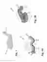 Fig. 02 - Method of bladder augmentation with modified ileal segment and biologically compatible tissue