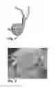Fig. 04 - Method of bladder augmentation with modified ileal segment and biologically compatible tissue