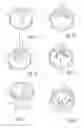 Fig. 06 - Urological device having a bladder retainer and a valve
