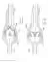 Fig. 14 - Urological device having a bladder retainer and a valve