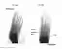 Fig. 17 - TENDON AND LIGAMENT FIXATION DEVICE AND METHOD OF USE