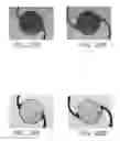 Fig. 23 - Wide depth of focus vortex intraocular lenses and associated methods