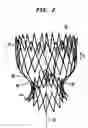 Fig. 03 - Collapsible and re-expandable prosthetic heart valve cuff designs and complementary technological applications