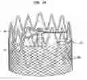 Fig. 18 - Collapsible and re-expandable prosthetic heart valve cuff designs and complementary technological applications