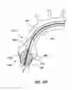 Fig. 26 - Delivery device for a stented prosthetic heart valve