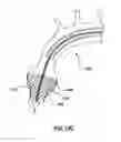 Fig. 27 - Delivery device for a stented prosthetic heart valve