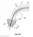 Fig. 32 - Delivery device for a stented prosthetic heart valve