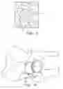 Fig. 04 - ORTHOPAEDIC IMPLANTS WTIH TEXTURED POROUS SURFACES