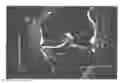 Fig. 01 - Osteoarthritis treatment and device