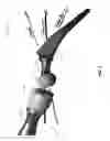 Fig. 08 - SURGICAL IMPACTION CENTERING APPARATUS AND METHOD