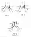 Fig. 02 - Systems and methods for deploying a luminal prosthesis over a carina