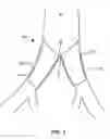 Fig. 03 - Systems and methods for deploying a luminal prosthesis over a carina