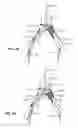 Fig. 11 - Systems and methods for deploying a luminal prosthesis over a carina