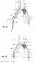 Fig. 12 - Systems and methods for deploying a luminal prosthesis over a carina