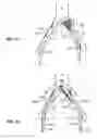 Fig. 13 - Systems and methods for deploying a luminal prosthesis over a carina