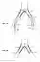 Fig. 14 - Systems and methods for deploying a luminal prosthesis over a carina