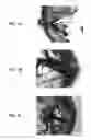 Fig. 07 - Stents having protruding drug-delivery features and associated systems and methods