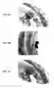 Fig. 08 - Stents having protruding drug-delivery features and associated systems and methods