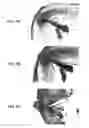 Fig. 14 - Stents having protruding drug-delivery features and associated systems and methods